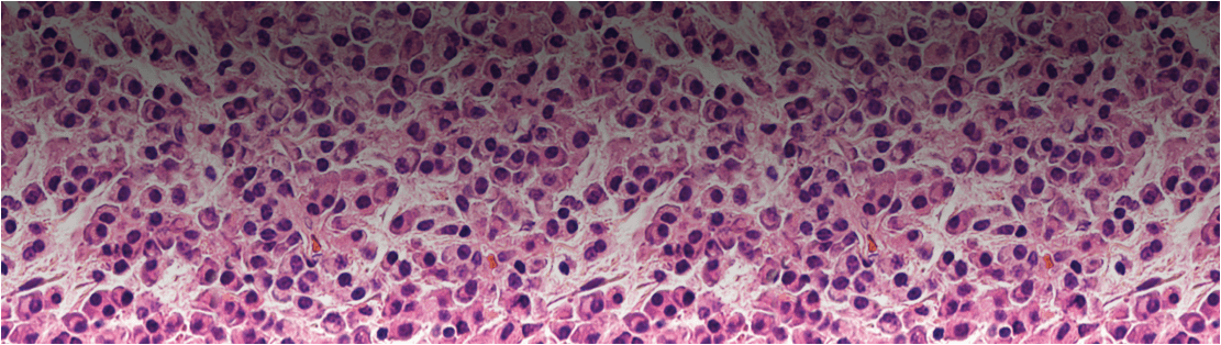 Comprendere il Mieloma Multiplo