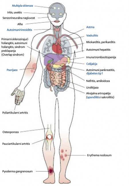 Crohn_about-disease_Upala_gastrointestinalnog_trakta.jpg