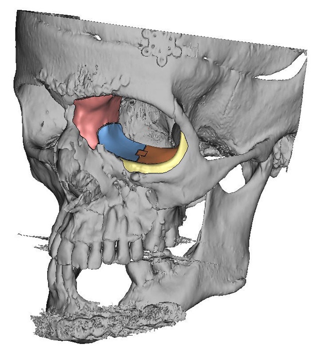 Cranial implant company swears by PEEK, touts industry-leading turn-around time