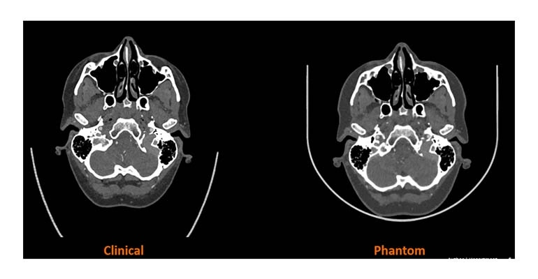 medical imaging phantom compared with clinical scan