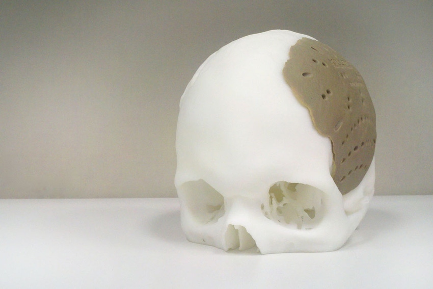 3D-printed PEKK stakes out implant position