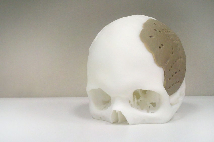 3D-printed PEKK stakes out implant position 3D-printed PEKK stakes out implant position