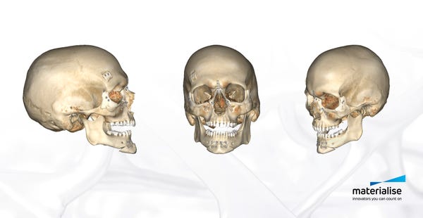 Skull-post-surgery.jpg