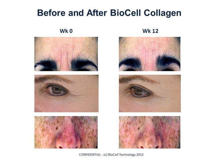 BioCell_20skin_20studies-Before_20and_20After_20Images_20Informa_4.jpg