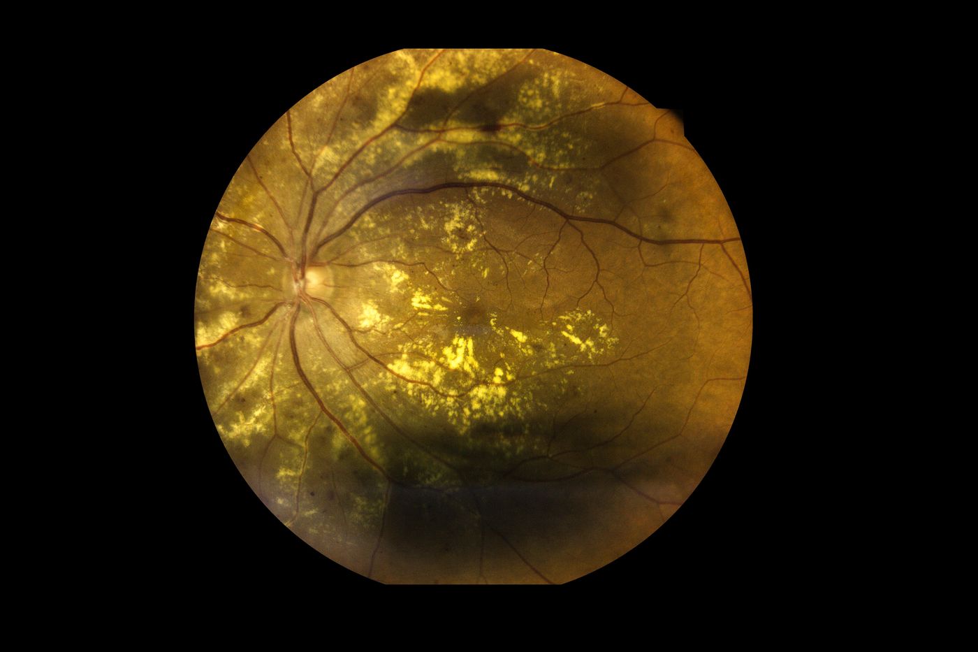 Why Retinal Diseases Could Become the Proving Ground for the Next Generation of Regenerative Therapies