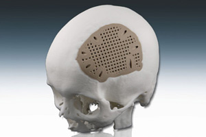 PEEK Cranial Implant Debuts at MD&M