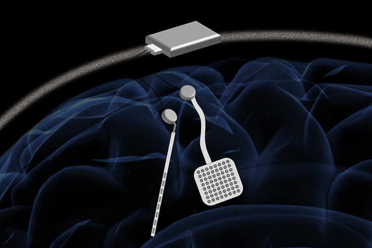 Researchers Develop Wireless 'Pacemaker' for the Brain