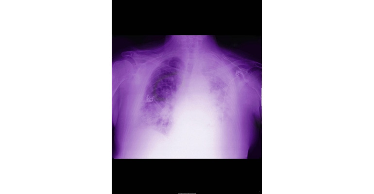 X-ray of lung with mesothelioma artificial intelligence
