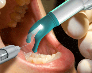 DentalVibe Tricks Brain to Cut Pain