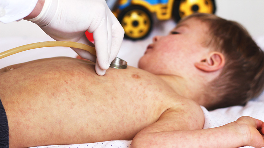 Niño acostado con Rubeola