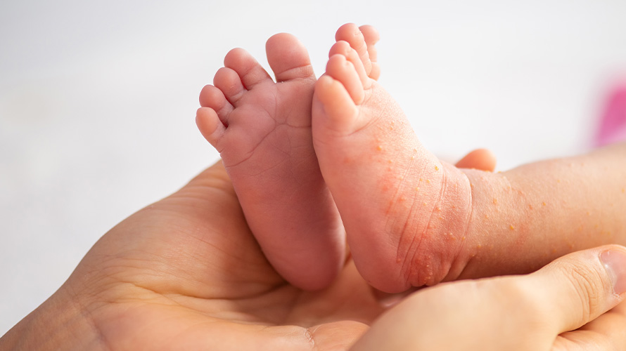 Bebé con infecciones en la piel