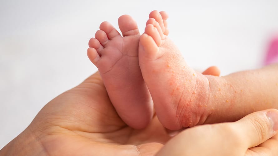 Bebé con infecciones en la piel