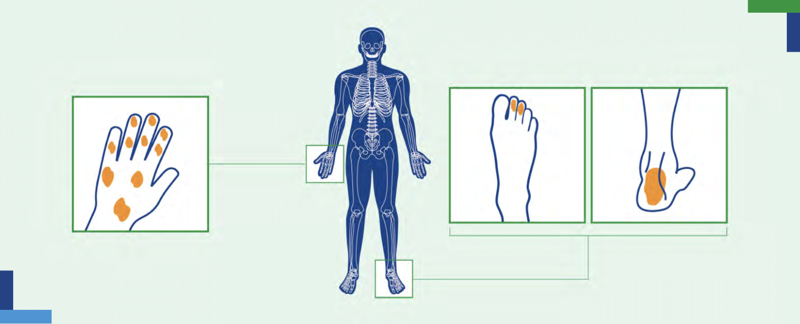 How psoriatic arthritis affects the body4