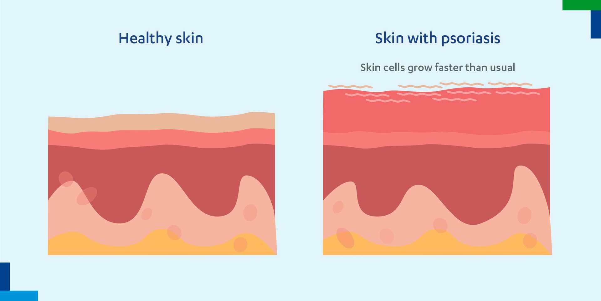 Introductionin Pso What is Psoriasis (Pso)? | J&J WithMe