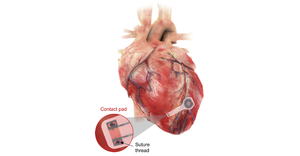 bioresorbable pacemaker