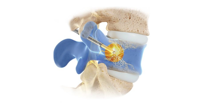 Image of Intracept procedure that Carson Daly had, showing the probe in the bone.