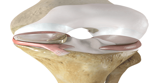 FDA Grants Breakthrough Designation to 'Artificial Meniscus'