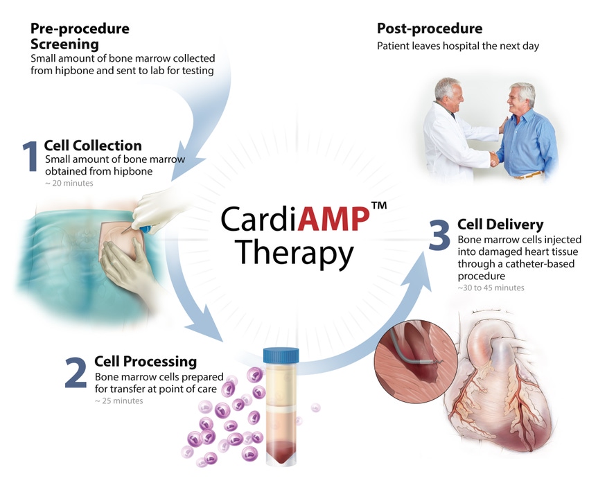 BioCardia Developing Comprehensive Approach to Treat Heart Failure
