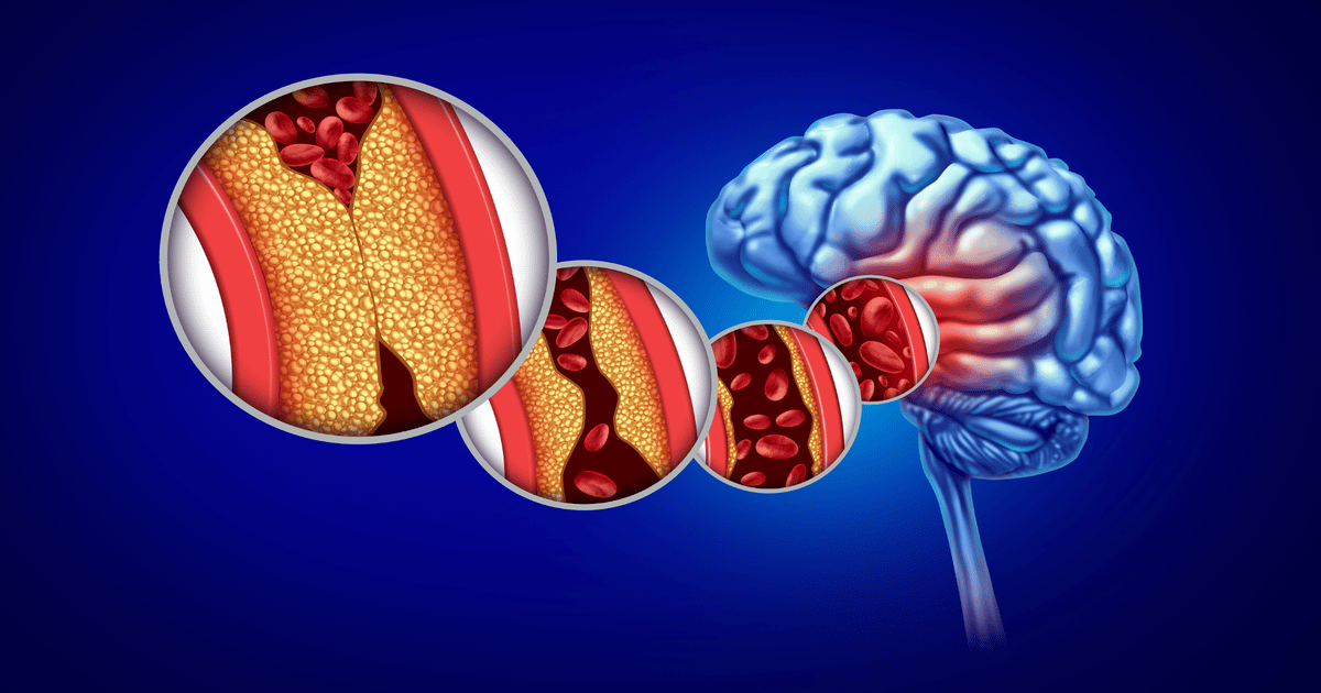 InspireMD Recalls CGuard Prime Stent Delivery System