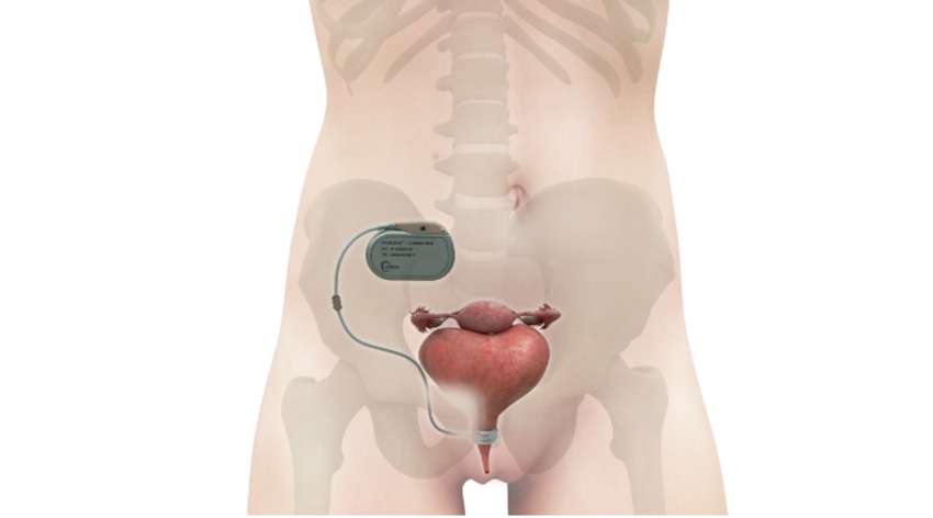 UroMems' automated artificial sphincter system shown in an illustration of a male anatomy