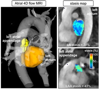 Northwestern 4-D imaging MRI stroke