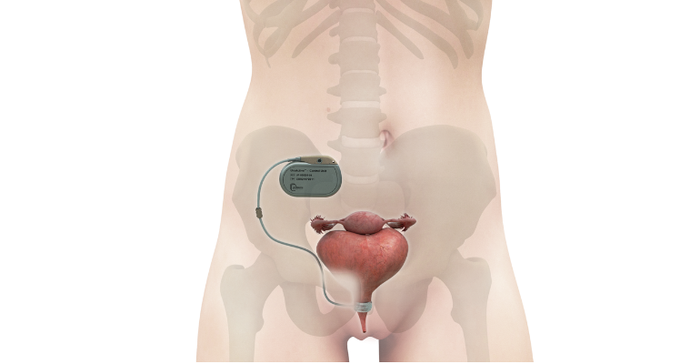 UroActive automated artificial sphincter system designed to treat stress urinary incontinence. Diagram shows the device impanted in a female anatomy..png