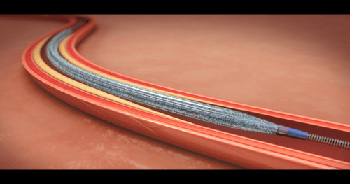 FDA Approves Medtronic's Drug-Coated Balloon For PAD In Upper Leg