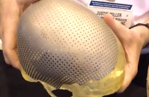 Major Trauma Patients Can Look Toward Photochemical Etching for Super Thin Implants (video)