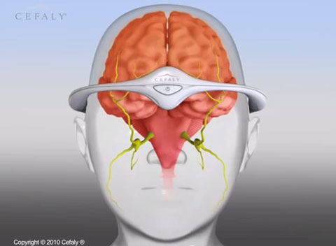 FDA Clears First Medical Device for Preventing Migraine Headaches