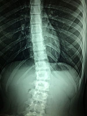 Data and Analytics Can Deliver Spinal Device Sales