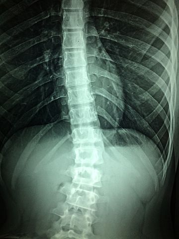 Data and Analytics Can Deliver Spinal Device Sales