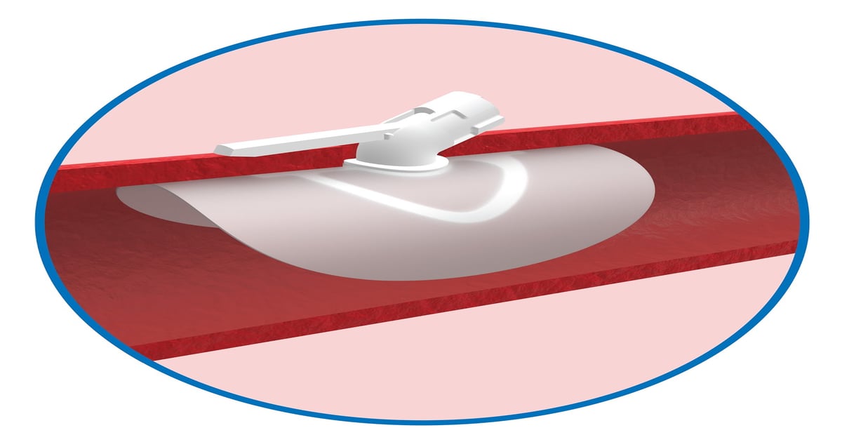 Vivasure Launches Large Bore Closure Device in Europe