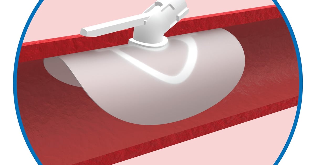 Bore Closure Rings Vivasure Launches Large Bore Closure Device in Europe