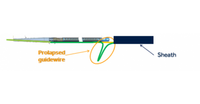 Medtronic TurboHawk diagram showing prolapsed guidewire.png