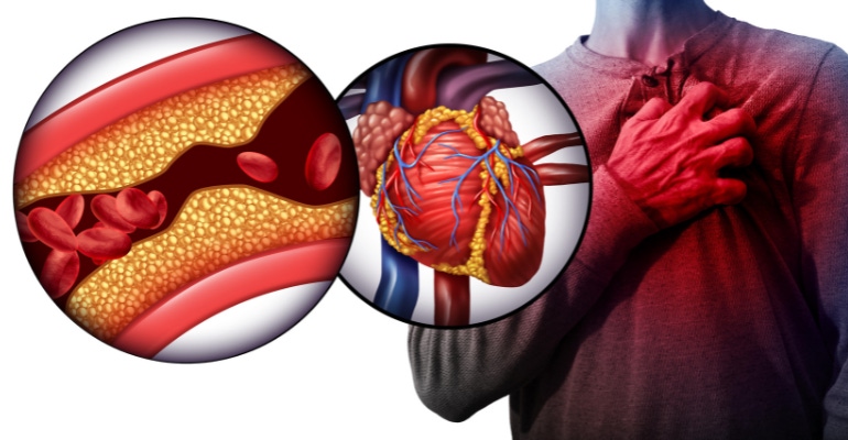 heart disease illustration