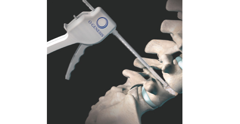 Medtronic Proves to be a 'Titan' in Spine
