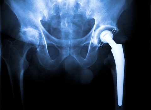 Homegrown Orthopedic Joint Makers Gain Marketshare in Asia