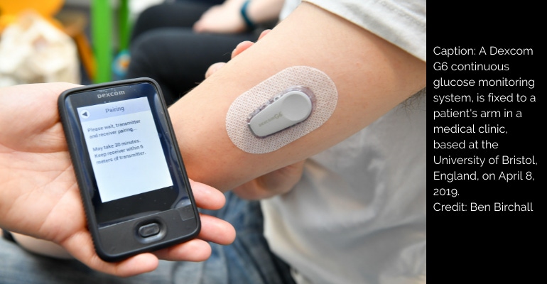 A Dexcom G6 continuous glucose monitoring system, is fixed to a patient's arm in a medical clinic, based at the University