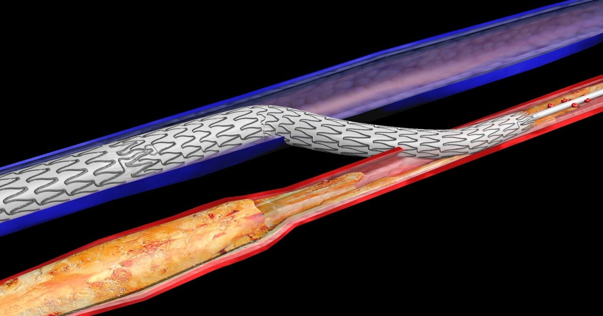 LimFlow Shows ‘PROMISE’ During VIVA