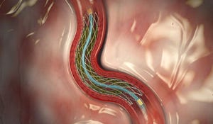 Medtronic Stent First to Earn Indication for Heart Disease Patients with Diabetes