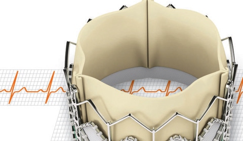 TAVR: Still the Next Big Thing in Cardiology?