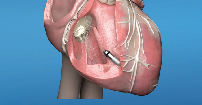 Medtronic Micra Leadless Pacemaker implanted in the heart.