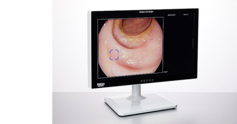 AI-Powered Colorectal Polyp Detector Finds Unremarkable Lesions