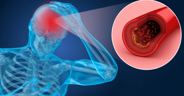 How AI Can Improve CTA Analysis After Stroke and Heart Attack