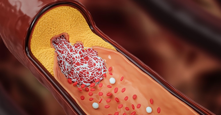 Diseased artery or blood vessel clogged by cholesterol or atheroma plaque and blood clot 3D rendering illustration