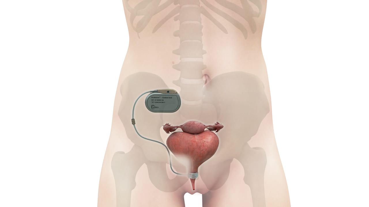 glp 1 urinary incontinence Can Diabetes Medications Cause Incontinence? A Smart Automated Artificial Urinary