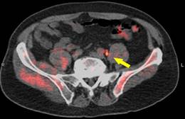 Better Imaging for Prostate Cancer Patients?