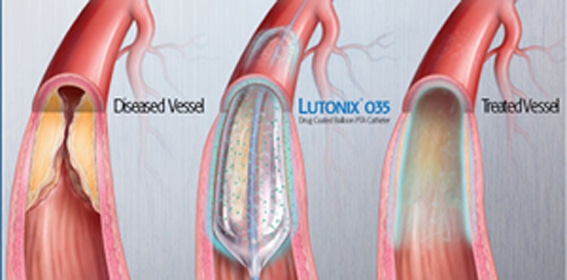 Bard's Drug-Coated Angioplasty Balloon Continues to Show Efficacy
