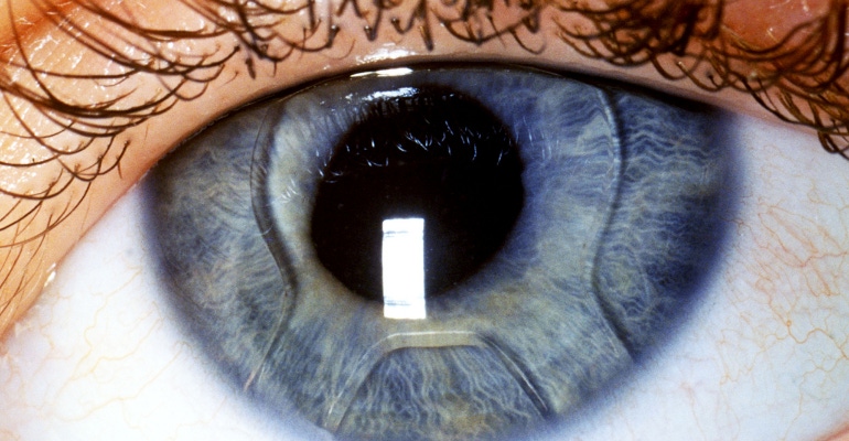closeup of an eye with an intraocular lens after cataract surgery