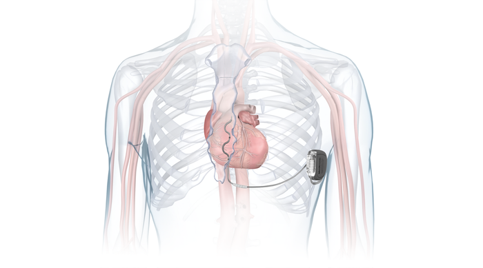 Medtronic_Aurora_EV-ICD_illustration_of_where_the_device_and_the_lead_is_placed_in_the_anatomy.png